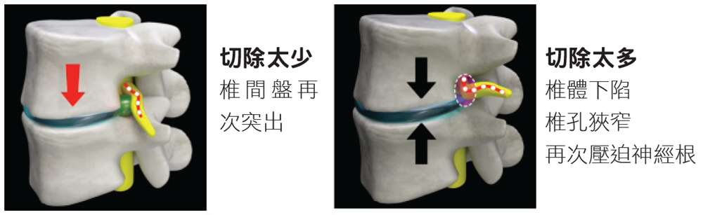 椎體下塌與椎間盤再突出示意